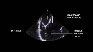 Grading mitral stenosis [upl. by Gerti]