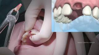 LIVE SURGERY DENTAL EXTRACTION AND BONE GRAFT [upl. by Dnalerb]