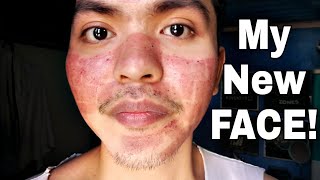 My Fractional CO2 Laser Treatment Experience TAGALOG [upl. by Loren]