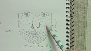 Embryology cleft lip [upl. by Oraneg]