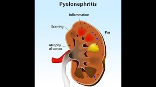 How is urethritis treated  Frankfort Regional Medical Center [upl. by Amaryl90]