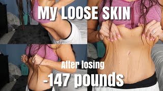 Loose Skin After Losing 147 lbs [upl. by Algar]