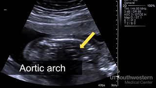 Fetal Distress Ultrasound and Heart Monitor [upl. by Adihahs]